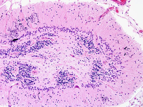 4K2 Cerebroretinal vasculopathy, CRV, RVCL, TREX, HERNS, Case 4) N9 H&E 4