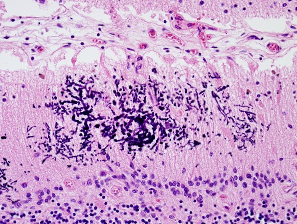 4K4 Cerebroretinal vasculopathy, CRV, RVCL, TREX, HERNS, Case 4) N9 H&E 5