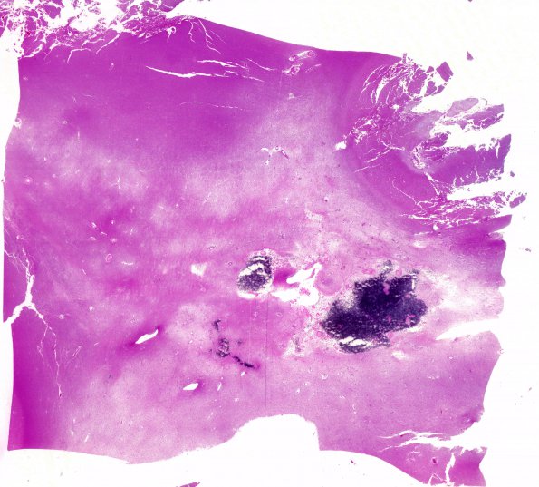 4L1 Cerebroretinal vasculopathy, CRV, RVCL, TREX, HERNS, Case 4) N12 H&E WM