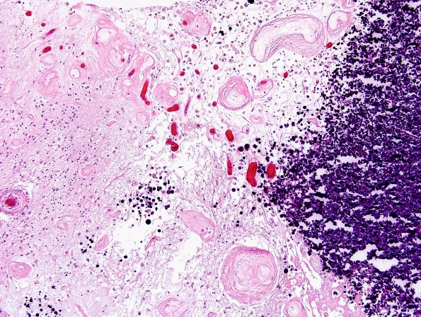 4L2 Cerebroretinal vasculopathy, CRV, RVCL, TREX, HERNS, Case 4) N12 H&E 8