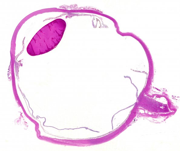 4M1 Cerebroretinal vasculopathy, CRV, RVCL, TREX, HERNS, Case 4) 1DD-L4 H&E WM