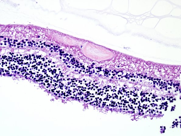 4M2 Cerebroretinal vasculopathy, CRV, RVCL, TREX, HERNS, Case 4) 1DD-L4 H&E 6