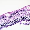 4M3 Cerebroretinal vasculopathy, CRV, RVCL, TREX, HERNS, Case 4) 1DD-L4 H&E 11