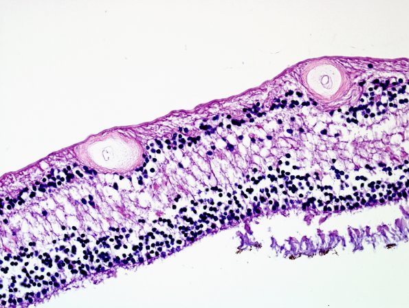 4M3 Cerebroretinal vasculopathy, CRV, RVCL, TREX, HERNS, Case 4) 1DD-L4 H&E 11