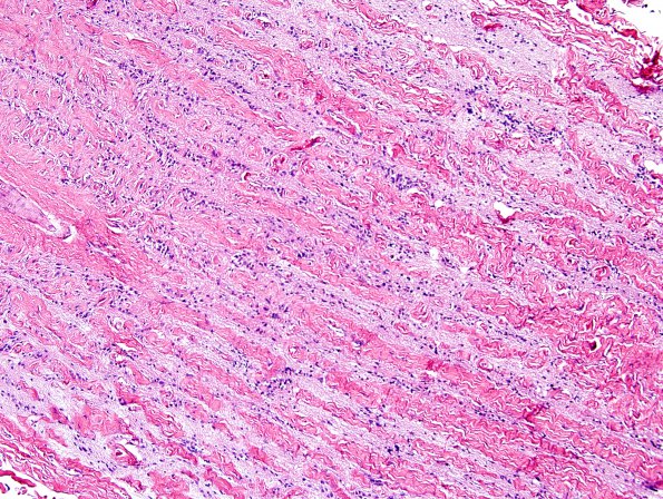 4M4 Cerebroretinal vasculopathy, CRV, RVCL, TREX, HERNS, Case 4) 1DD-L4 H&E 8