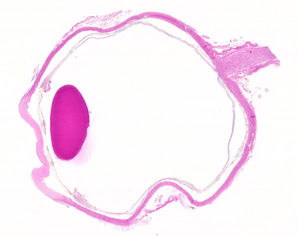 4N1 Cerebroretinal vasculopathy, CRV, RVCL, TREX, HERNS, Case 4) 1DD-R4 H&E WM