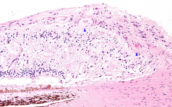 4N2 Cerebroretinal vasculopathy, CRV, RVCL, TREX, HERNS, Case 4) 1DD-R4 H&E 4A copy