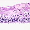 4N3 Cerebroretinal vasculopathy, CRV, RVCL, TREX, HERNS, Case 4) 1DD-R4 H&E 4