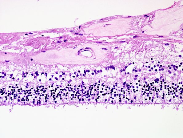 4N3 Cerebroretinal vasculopathy, CRV, RVCL, TREX, HERNS, Case 4) 1DD-R4 H&E 4