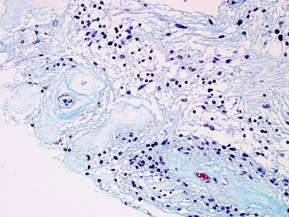 4N4 Cerebroretinal vasculopathy, CRV, RVCL, TREX, HERNS, Case 4) 1DD-R4 Trichrome 2