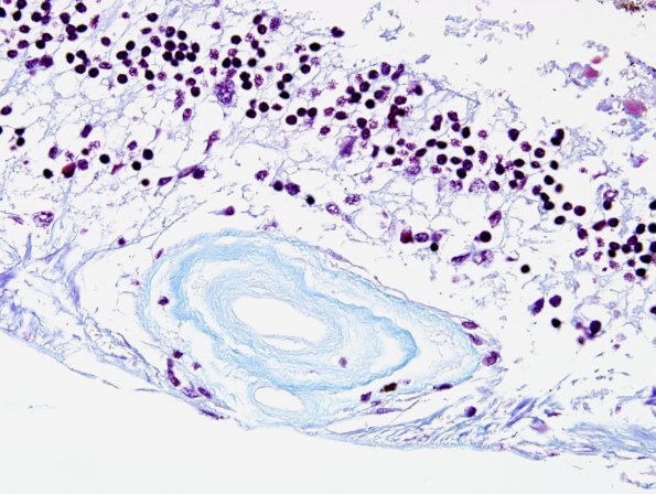 4N5 Cerebroretinal vasculopathy, CRV, RVCL, TREX, HERNS, Case 4) 1DD-R4 Trichrome 3
