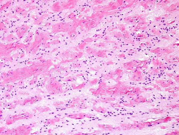 4N6 Cerebroretinal vasculopathy, CRV, RVCL, TREX, HERNS, Case 4 ) LGN 1DD R4 H&E 6