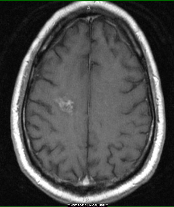 5A2 CRV (Case 5) correct T1 with contrast - Copy