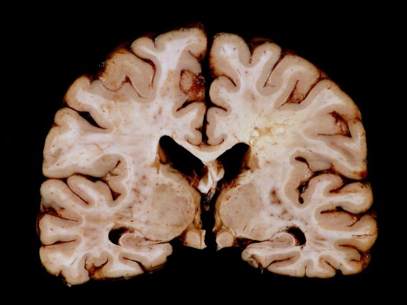 5B1 Cerebroretinal Vasculopathy, CRV, RVCL, TREX, HERNS, Case 5) 7