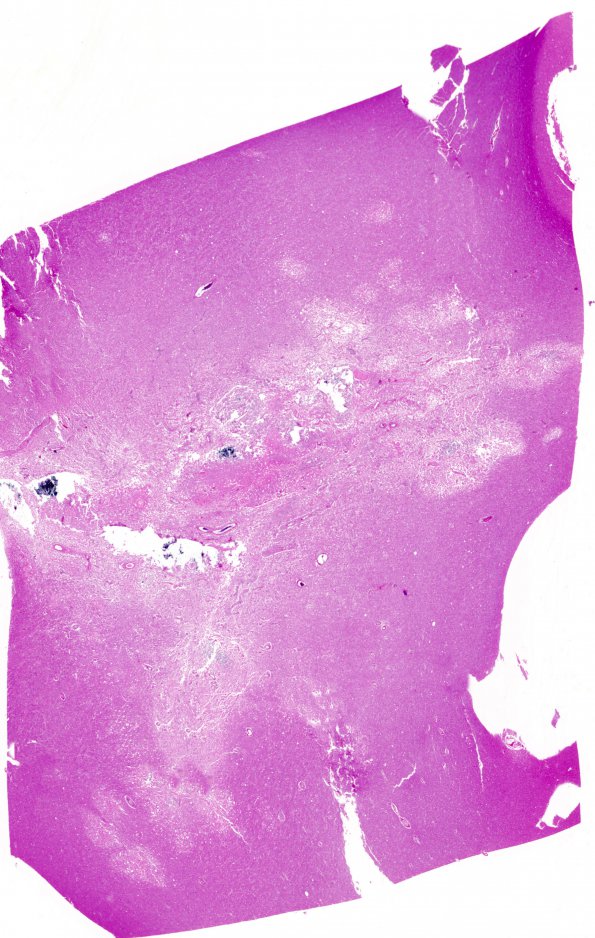 5C1 Cerebroretinal Vasculopathy, CRV, RVCL, TREX, HERNS, Case 5 N12 H&E WM