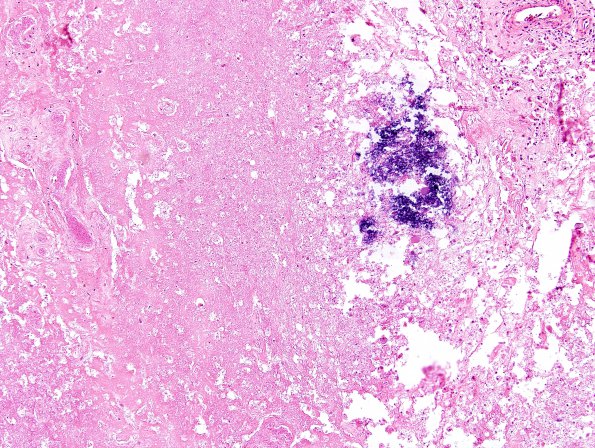 5C2 Cerebroretinal Vasculopathy, CRV, RVCL, TREX, HERNS, Case 5) N12 H&E 2 (2)