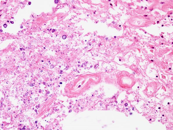 5C3 Cerebroretinal Vasculopathy, CRV, RVCL, TREX, HERNS, Case 5) N12 H&E 4 (2)