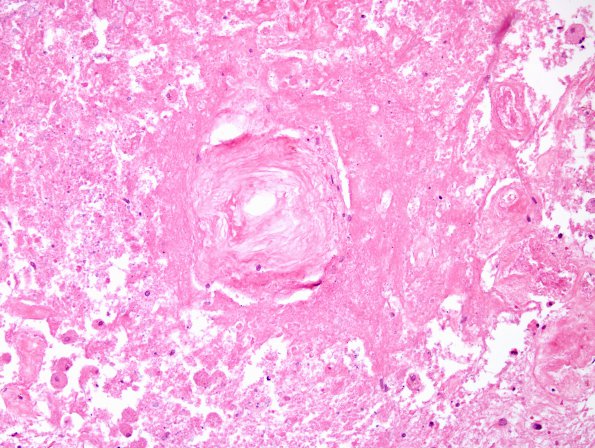 5C4 Cerebroretinal Vasculopathy, CRV, RVCL, TREX, HERNS, Case 5) N12 H&E 8 (2)