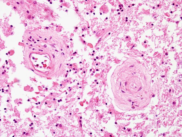 5C5 Cerebroretinal Vasculopathy, CRV, RVCL, TREX, HERNS, Case 5) N12 H&E 9 (2)