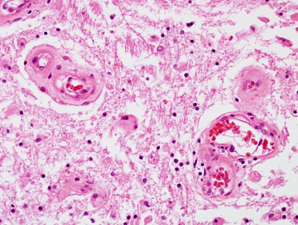 5C6 Cerebroretinal Vasculopathy, CRV, RVCL, TREX, HERNS, Case 5) N12 H&E 13 (2)