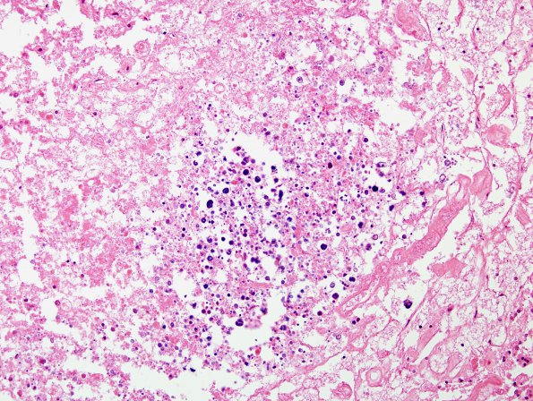 5C7 Cerebroretinal Vasculopathy, CRV, RVCL, TREX, HERNS, Case 5) N12 H&E 17 (2)