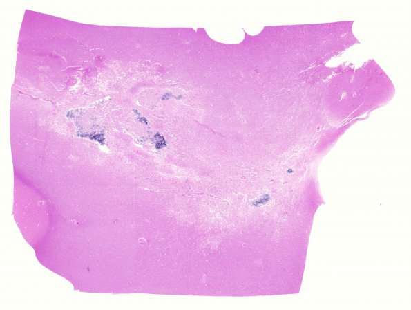 5D1 Cerebroretinal Vasculopathy, CRV, RVCL, TREX, HERNS, Case 5) N11 H&E WM