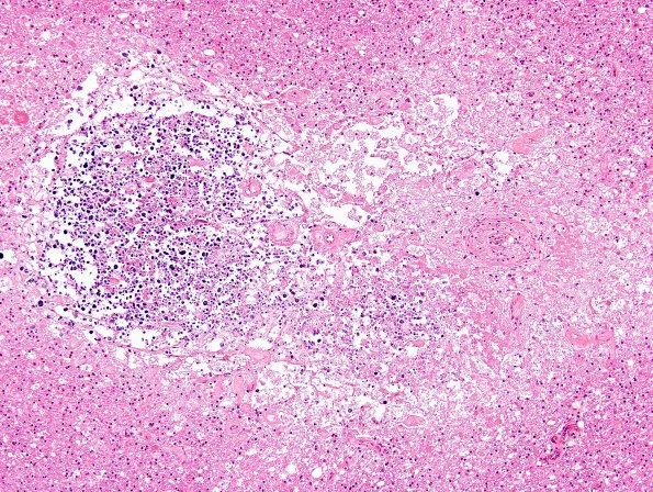 5D2 Cerebroretinal Vasculopathy, CRV, RVCL, TREX, HERNS, Case 5) N15 H&E 1 (2)