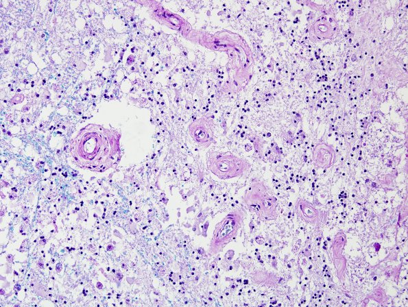 5D3 Cerebroretinal Vasculopathy, CRV, RVCL, TREX, HERNS, Case 5) LFB-PAS 20X (2)