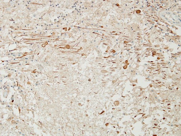 5D4 Cerebroretinal Vasculopathy, CRV, RVCL, TREX, HERNS, Case 5) NF 20X (2)