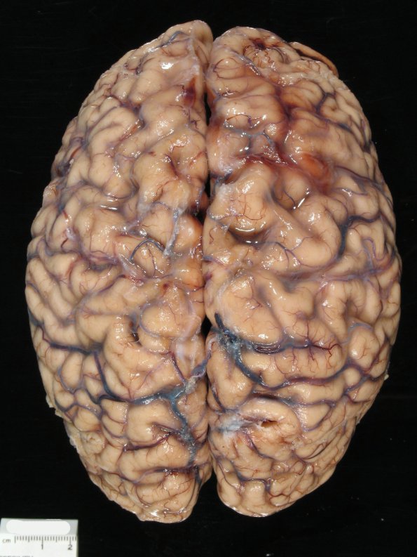 6A1 Cerebroretinal Vasculopathy, CRV, RVCL, TREX, HERNS, Case 6) 2