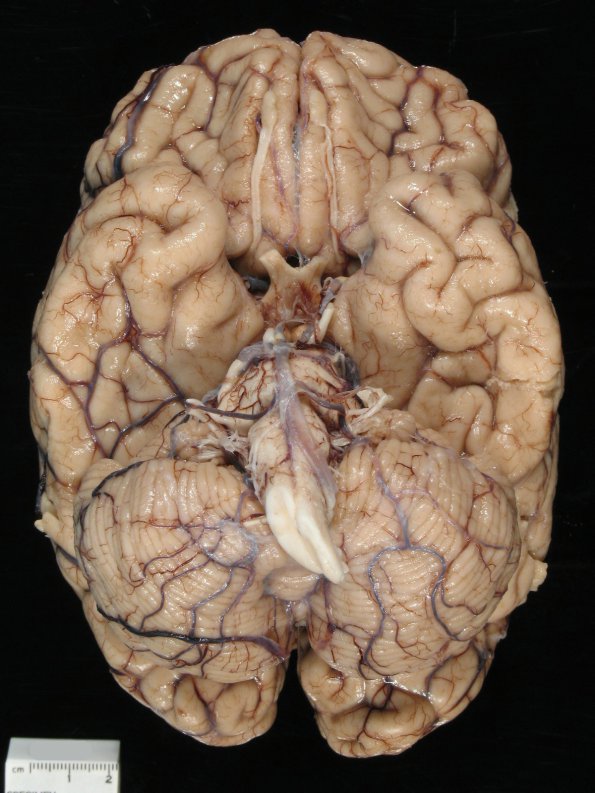 6A2 Cerebroretinal Vasculopathy, CRV, RVCL, TREX, HERNS, Case 6) 1