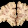 6A3 Cerebroretinal Vasculopathy, CRV, RVCL, TREX, HERNS, Case 6) 18