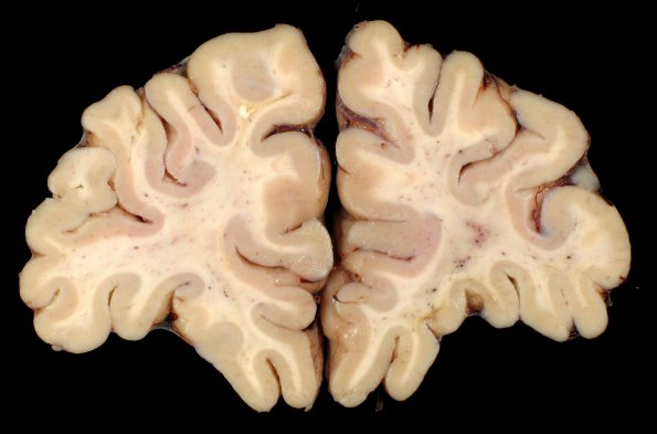 6A3 Cerebroretinal Vasculopathy, CRV, RVCL, TREX, HERNS, Case 6) 18