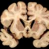 6A7 Cerebroretinal Vasculopathy, CRV, RVCL, TREX, HERNS, Case 6) 7a