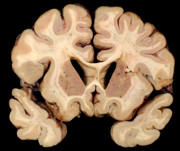 6A7 Cerebroretinal Vasculopathy, CRV, RVCL, TREX, HERNS, Case 6) 7a