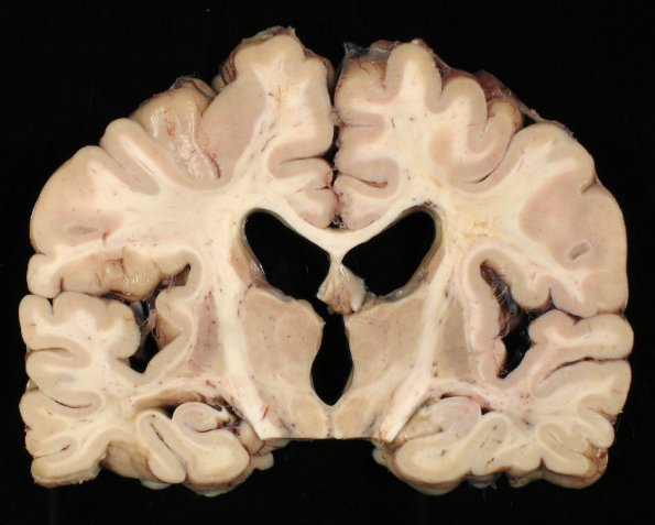 6A8 Cerebroretinal Vasculopathy, CRV, RVCL, TREX, HERNS, Case 6) 30