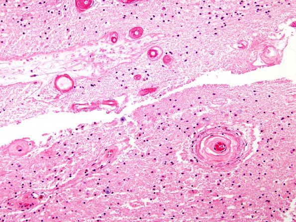 6B2 Cerebroretinal Vasculopathy, CRV, RVCL, TREX, HERNS, Case 6) H&E  6