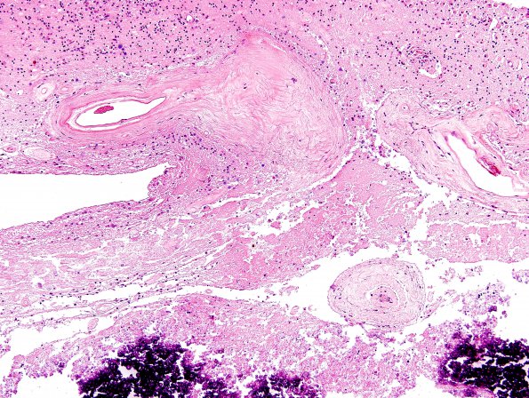 6B3 Cerebroretinal Vasculopathy, CRV, RVCL, TREX, HERNS, Case 6) H&E 1