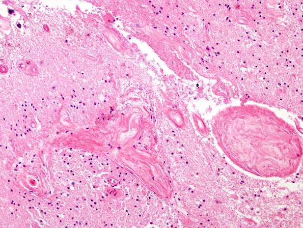 6B4 Cerebroretinal Vasculopathy, CRV, RVCL, TREX, HERNS,Case 6) H&E 10