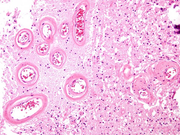 6B5 Cerebroretinal Vasculopathy, CRV, RVCL, TREX, HERNS, Case 6) H&E 13