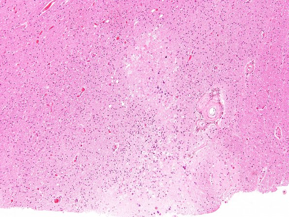 6B6 Cerebroretinal Vasculopathy, CRV, RVCL, TREX, HERNS, Case 6) H&E 5