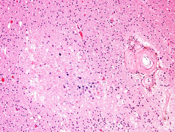 6B7 Cerebroretinal Vasculopathy, CRV, RVCL, TREX, HERNS, Case 6) H&E 12