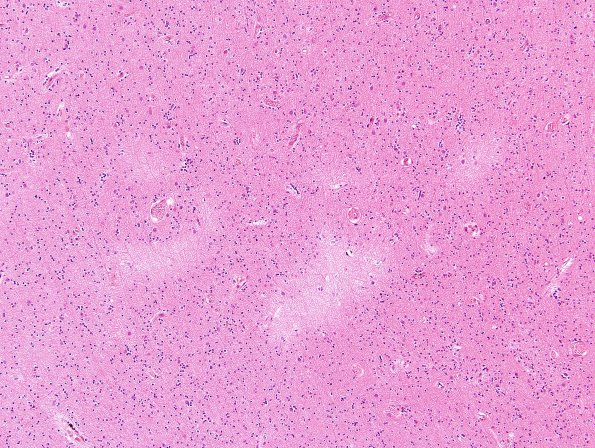 6B8 Cerebroretinal Vasculopathy, CRV, RVCL, TREX, HERNS, Case 6) H&E 8