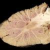 6C1 Cerebroretinal Vasculopathy, CRV, RVCL, TREX, HERNS, Case 6) 44