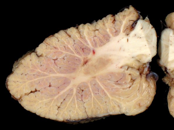 6C1 Cerebroretinal Vasculopathy, CRV, RVCL, TREX, HERNS, Case 6) 44