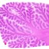 6C2 Cerebroretinal Vasculopathy, CRV, RVCL, TREX, HERNS, Case 6) Cerebellum 2 H&E WM