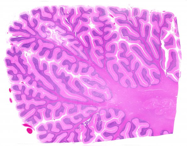 6C2 Cerebroretinal Vasculopathy, CRV, RVCL, TREX, HERNS, Case 6) Cerebellum 2 H&E WM