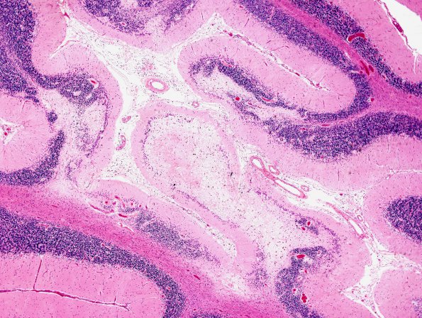 6C3 Cerebroretinal Vasculopathy, CRV, RVCL, TREX, HERNS, Case 6) Cerebellum H&E 1