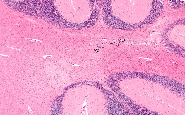 6C4A Cerebroretinal Vasculopathy, CRV, RVCL, TREX, HERNS, Case 6) H&E 4X