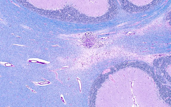 6C4B Cerebroretinal Vasculopathy, CRV, RVCL, TREX, HERNS, Case 6) LFB-PAS 4X  N9